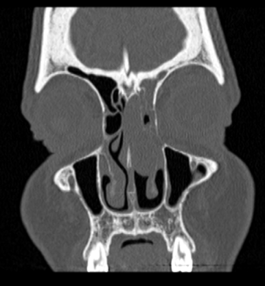 Sinuses On Ct Scan