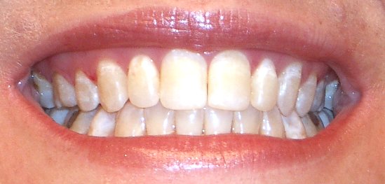 Drugstore teeth whitening