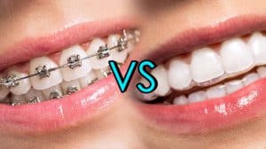 Braces-vs-Invisalign