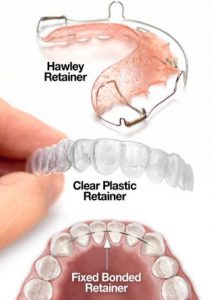 Three-Types-of-Retainers-1