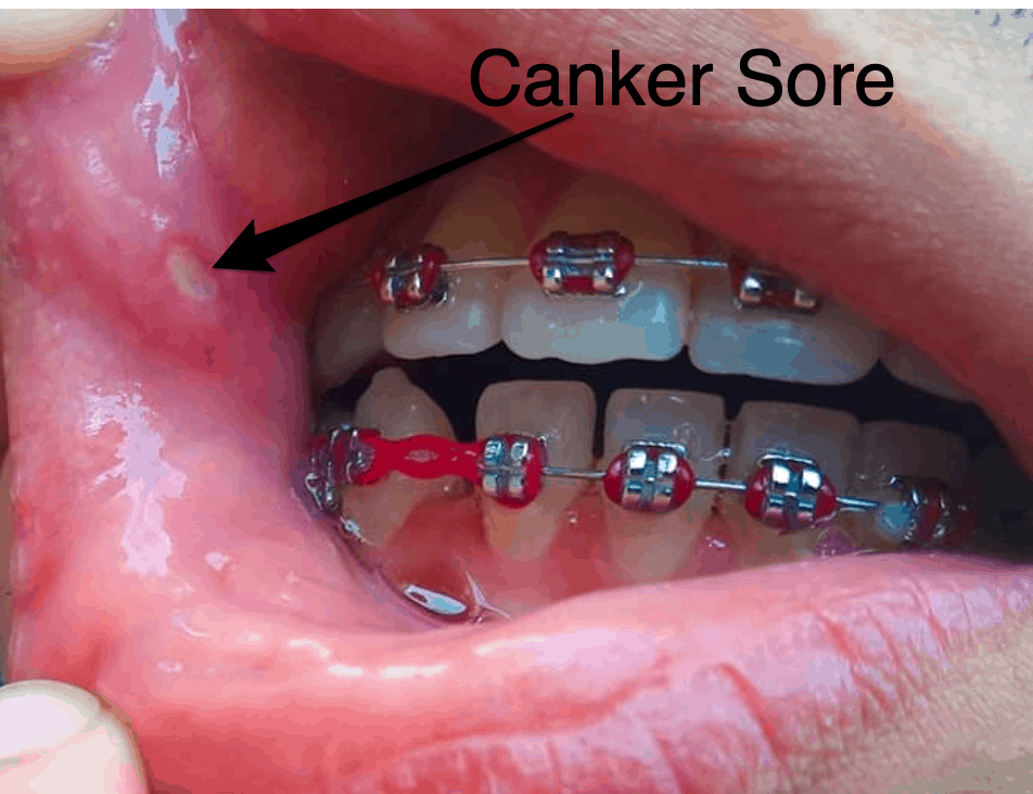 Ouch! I Have A Canker Sore! ArchWired