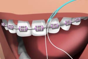 Flossing_Braces