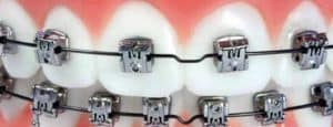 What Is An Orthodontic Tie Wire On Braces? - ArchWired