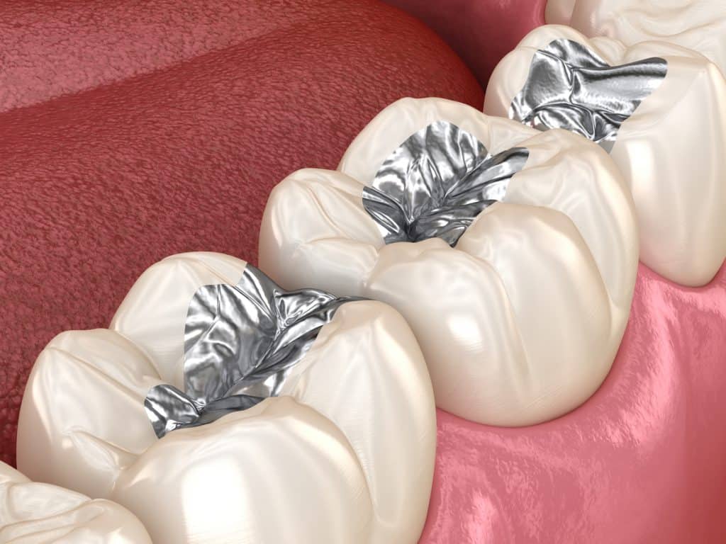 what-are-amalgam-fillings-in-dentistry-archwired