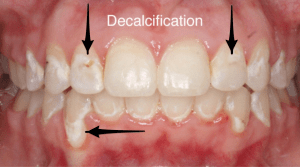 Decalcification