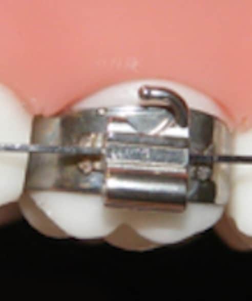 Did anyone have premolar bands? I mean the metal ones around a tooth ...