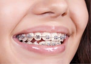 Orthodontic_Braces_Photo