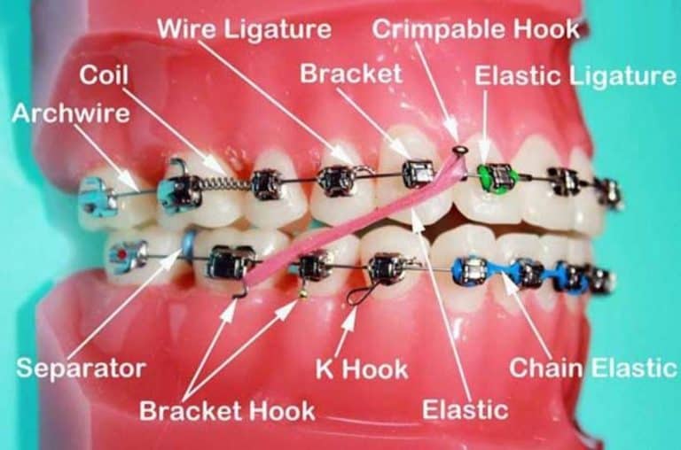 what-is-orthodontic-arch-wire-on-braces-archwired