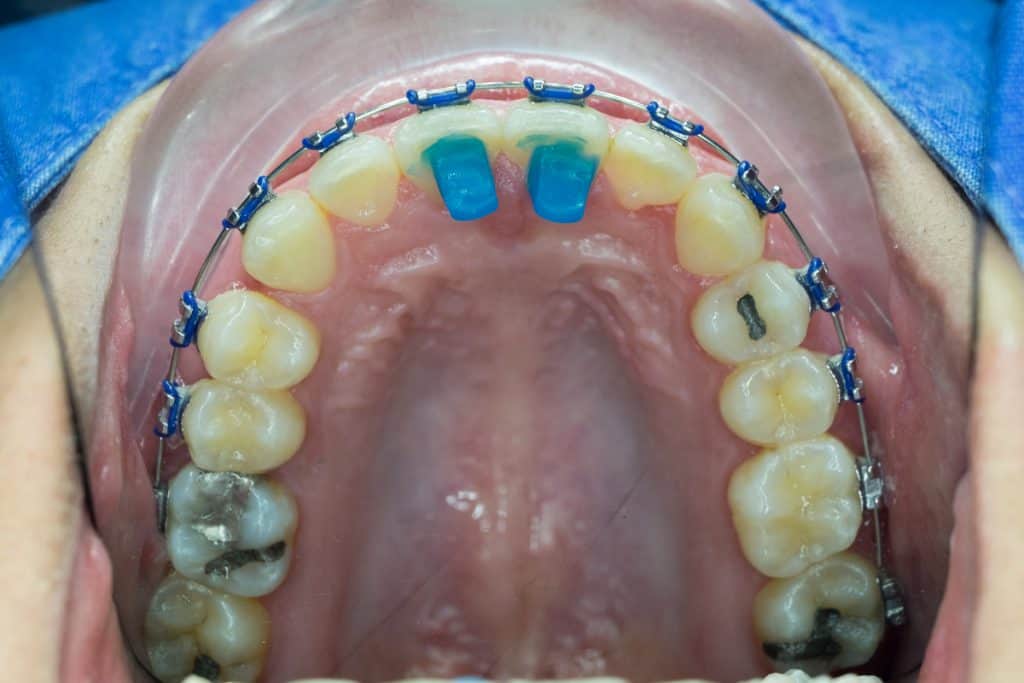 What Are Bite Turbos In Orthodontics? - ArchWired