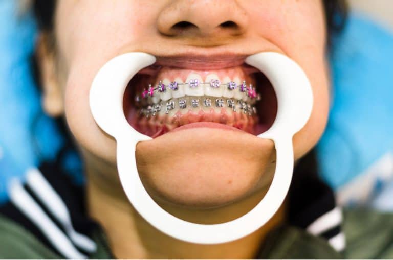 what-is-a-cheek-retractor-in-dentistry-or-orthodontics-archwired