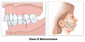 Class_II_Malocclusion