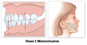 Class_I_Malocclusion