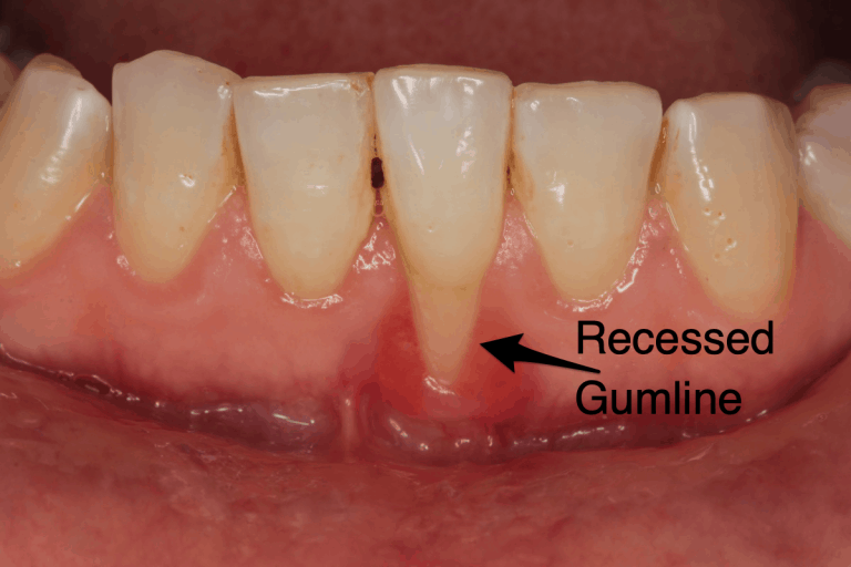 What Is Gum Recession in Dentistry? ArchWired