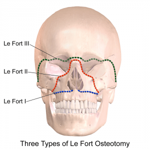 Le_Fort_Osteotomy