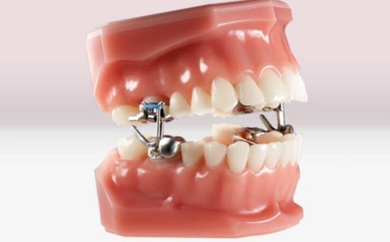 What Is A MARA Appliance In Orthodontics? - ArchWired