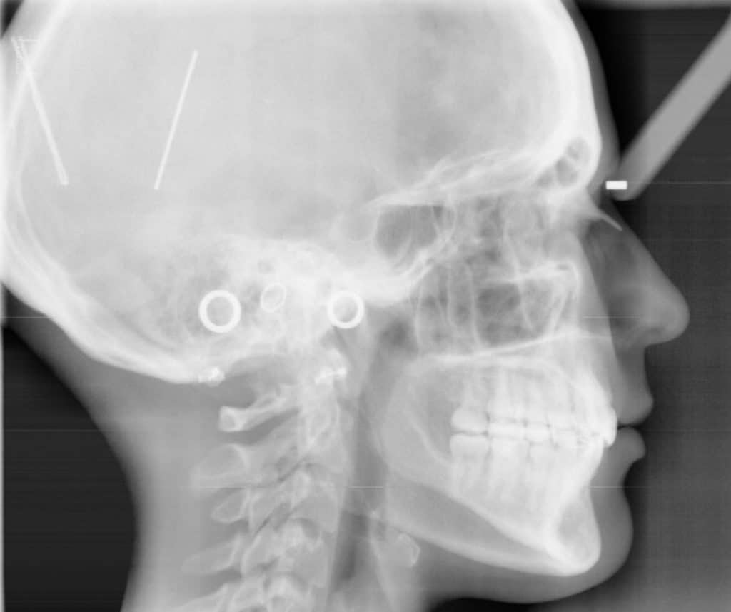 What Is A Cephalometric X-ray In Orthodontics? - ArchWired