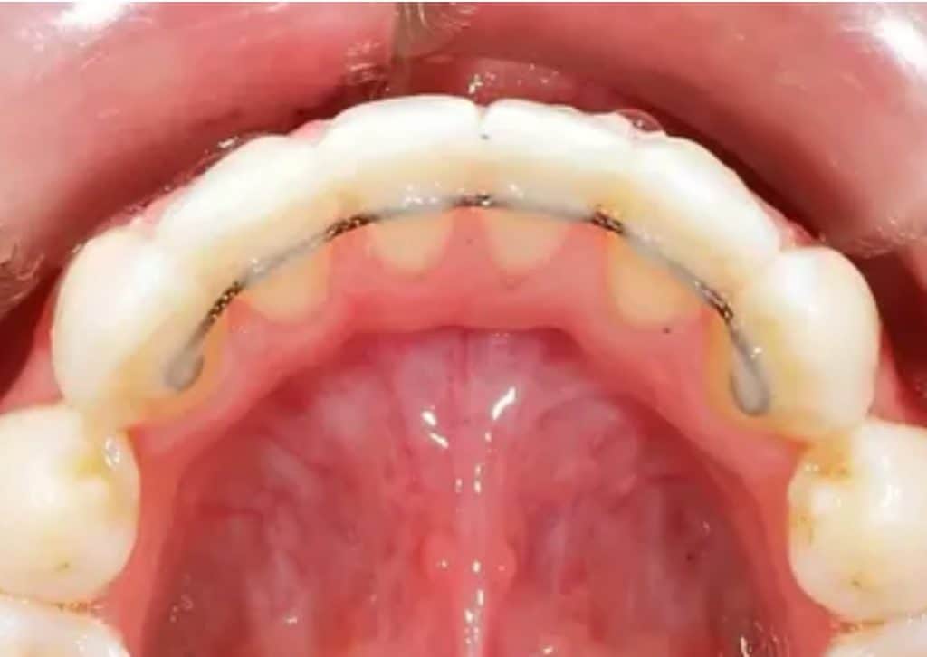 What Is A Fixed or Permanent Retainer In Orthodontics? ArchWired