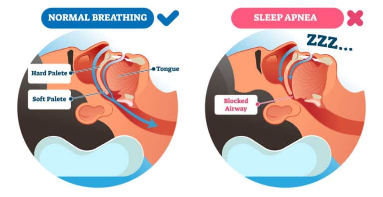 What Is Sleep Apnea? - Archwired