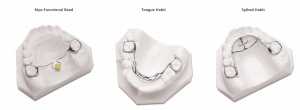 Tongue_Habit_Devices