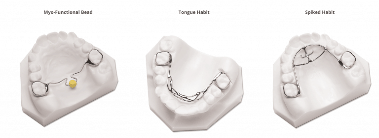 What Is A Tongue Habit Appliance In Orthodontics? - ArchWired