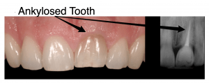 Ankylosed_Tooth