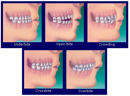 bite types