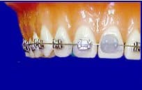 Braces_with_Dental_Wax