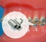 buccal tubes on bracket