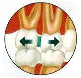 spacers for braces